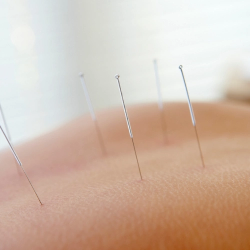 Aculpultura sistêmica aplicada a sessões de psicologia